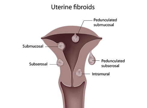 best hospital for fibroid surgery in Delhi, India