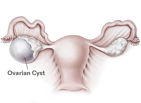 Ovarian Cyst Treatment In Delhi