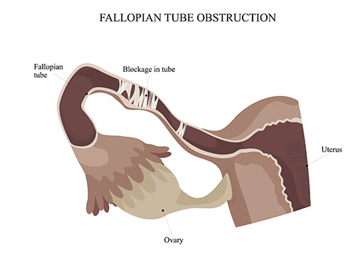 laparoscopy for blocked fallopian tubes treatment South Delhi, India