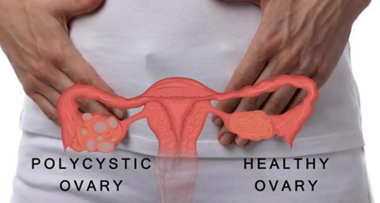 7 Symptoms Of Ovarian Cyst You Should Not Ignore