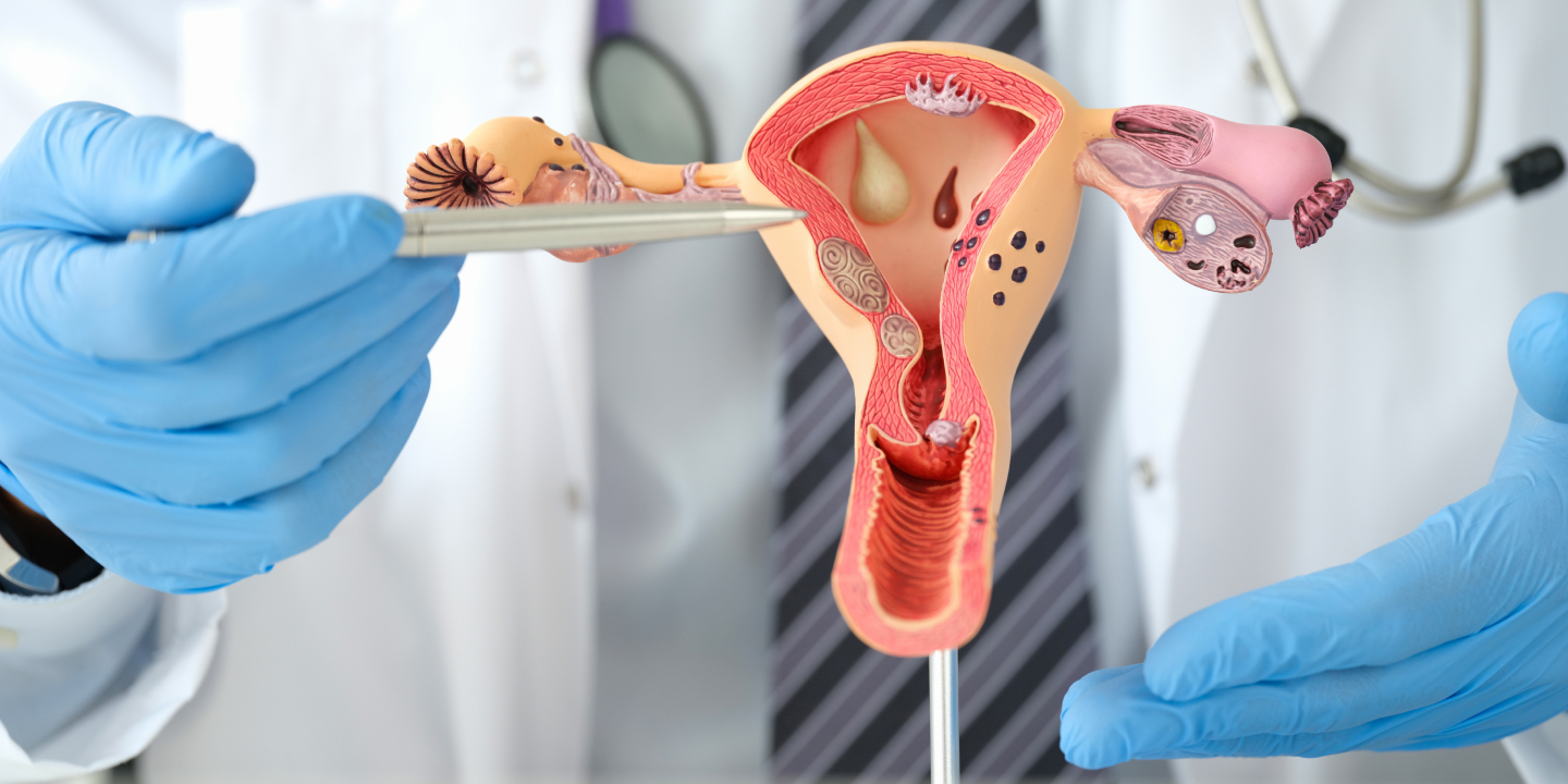 Ovarian Cyst: Symptoms, Causes, Diagnosis And Treatment Available