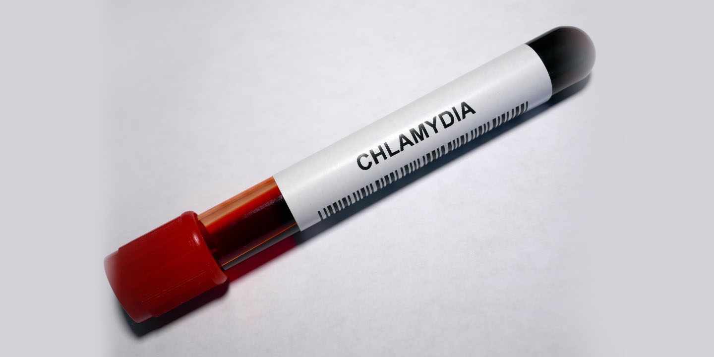 Gonorrhea and Chlamydia testing